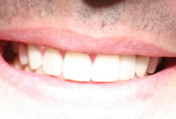 Porcelain Veneers