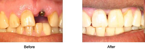 Dental Implants