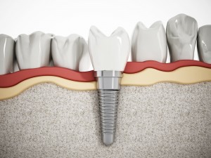 dentalimplants, smile, teeth, dentures